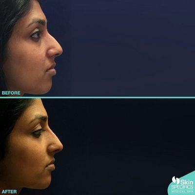 Nose Reshaping. Restylane Lyft - Perlane to nose bridge and tip and chin to achieve facial balance.