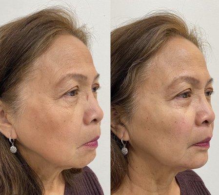 Before & After Filler