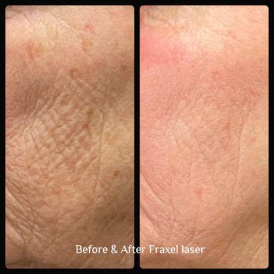 Before and after Fraxel laser procedure.