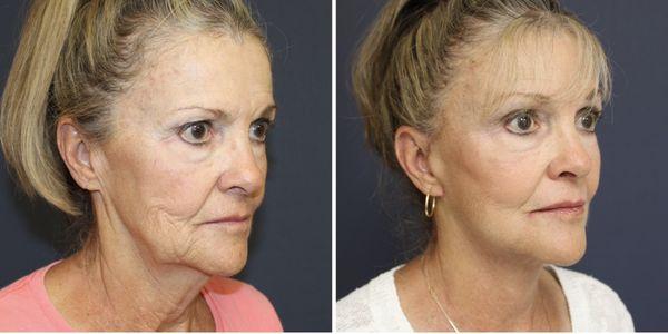 Before and after facelift