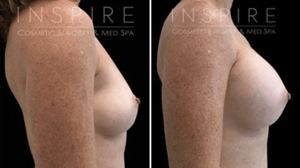 Breast Augmentation Before & After