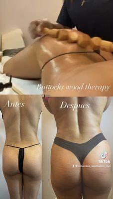 Buttocks lifting