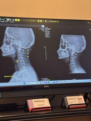 Neck before and after