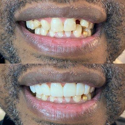 Removable veneers for crooked teeth