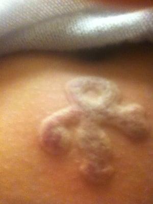 Tat Removal - Ouch!!