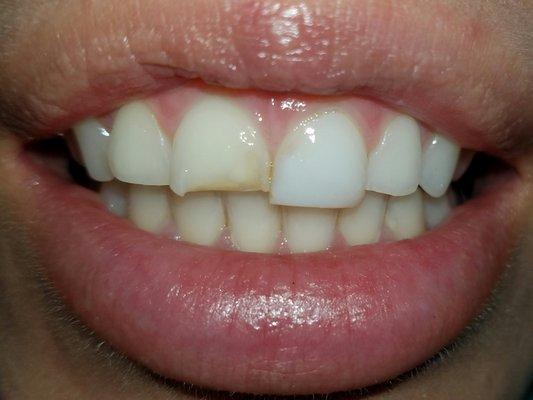 Before picture of anterior  veneers