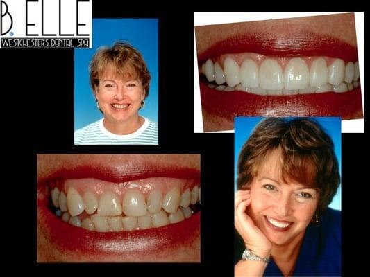 Porcelain Veneers or Invisalign.  The choice is yours.