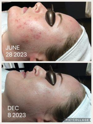 Mallory came to us on a SkinBetter routine for acne. We found the right balance for her easily reddened acne-prone skin.