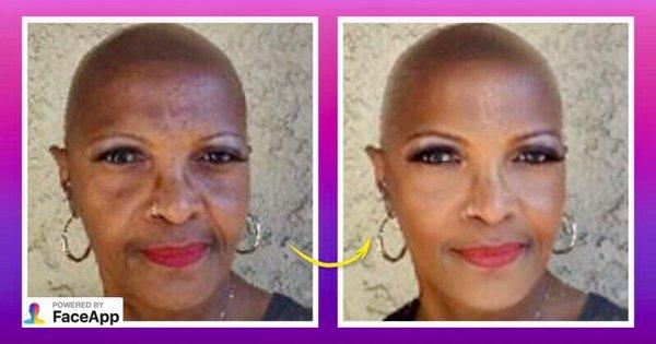 SMP can help anyone look and feel better. Alopecia client and cancer survivor! Before and after photos