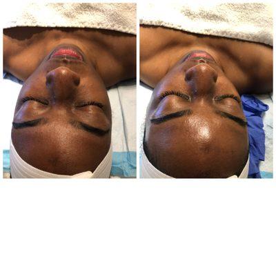 Hydro Facial