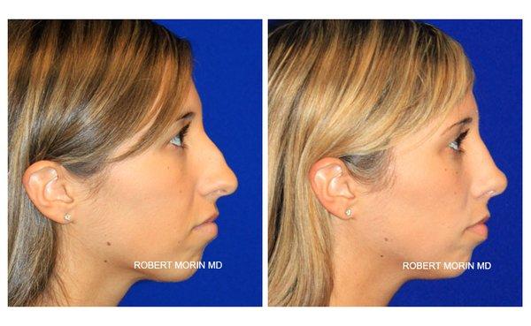 A 23 year old female patient suffering from airway obstruction was unhappy with the appearance of her nose undergoes a septorhinoplasty.