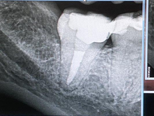 Root canal with a build up filling.  Will still need to get a crown.