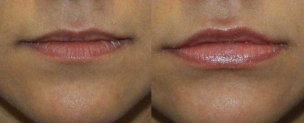 Lip Filler Before & After at VIDA Aesthetic Medicine in Salem, OR