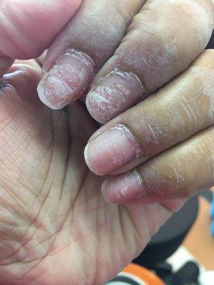 Nails ripped off