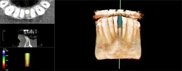 Implant planning