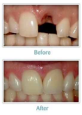 Before and after a dental implant and crown