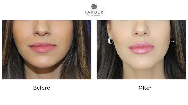 Before and After of lip filler. The patient wanted to add volume while still maintaining natural results