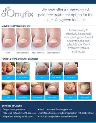 Our Nail Correction System is a completely painless solution to treat ingrown toenails.