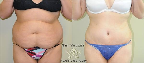 Liposuction and tummy tuck before and after by Tri Valley Plastic Surgery