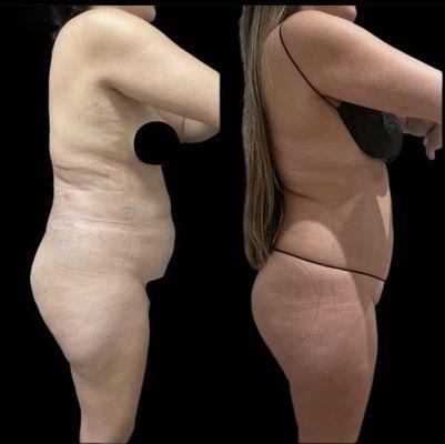 post-liposuction