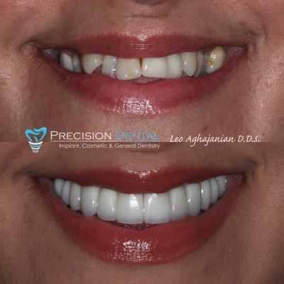 A balanced bite and an enchanting smile! Dr. Leo addressed his patient's jaw pain and cosmetic concerns with advanced restorative technique.