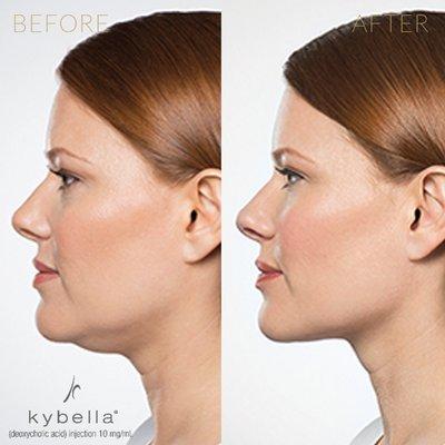 Kybella