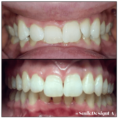 INVISALIGN Treatment to correct our patients Crowding Bite,  and Smile. Invisalign done with the right Dentist can change lives!!