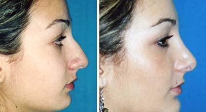 Rhinoplasty