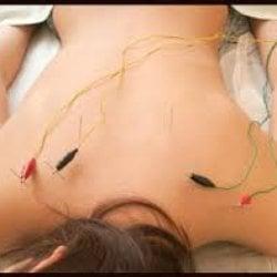 Acupuncture with Electricl stimulation