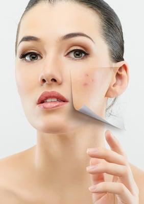 Laser Acne Treatments