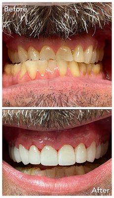 Full mouth rehab! Collapsed vertical dimension and severely worn enamel converted to an esthetic and functional smile :) #glendorasmile.com