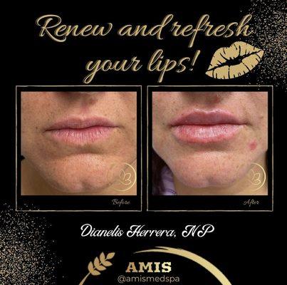 Another beautiful patient with Hyaluronic acid filler injected to lips. Better shape and juicy lips.