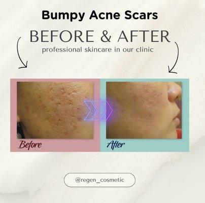 Bumpy acne scar care