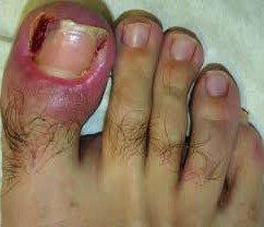 Ingrown toenail