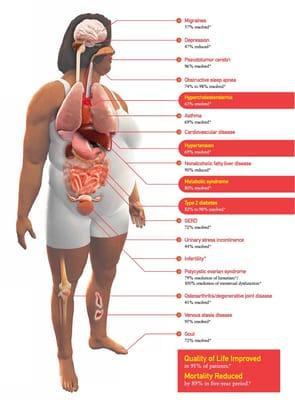 Weight loss Surgery: 70-90% improved quality of life, reduced rate of mortality, Diabetes, hypertension, etc.