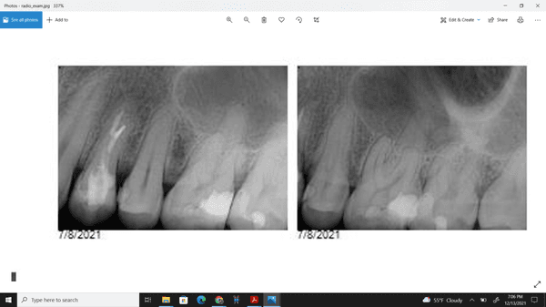 before the root canal, no infection