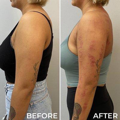 INMODE BODY CONTOURING  it's fast, it's easy and it's non-invasive! Get rid of all the stubborn fat on your body today!