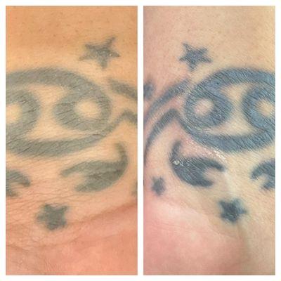 Magnetic Tattoo Removal Examples