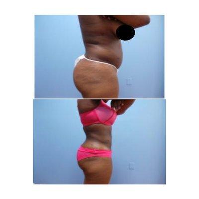 Liposuction