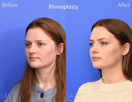 SKY Finesse rhinoplasty