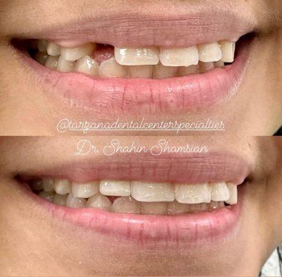 Before & After: Implant placement and Zirconia implant crown