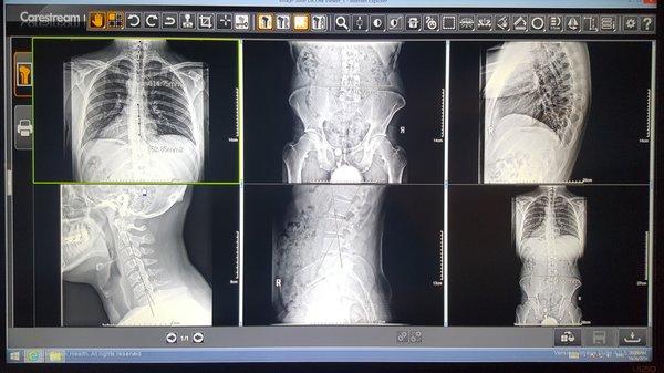 Full Digital X-rays