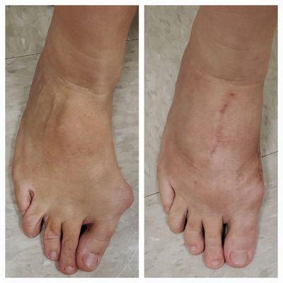 Before and after Bunion Correction