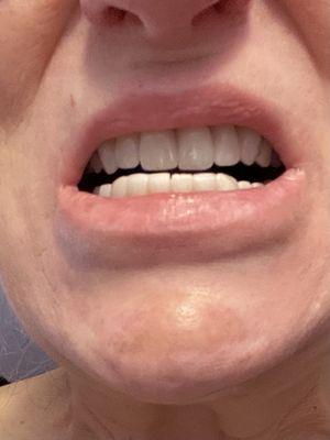 The crowns put on my lower teeth by Dr. Bernardini