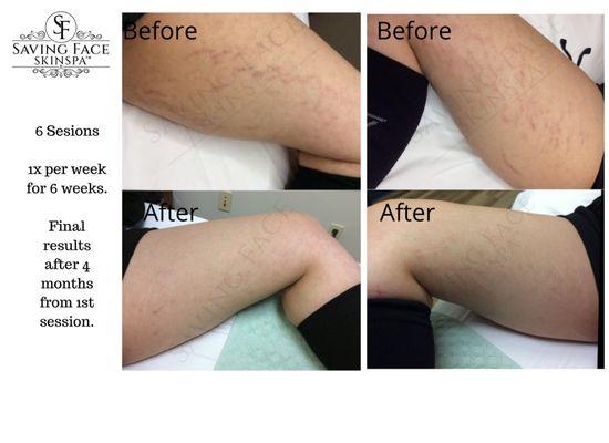 Stretch Mark Therapy. PRX-T33