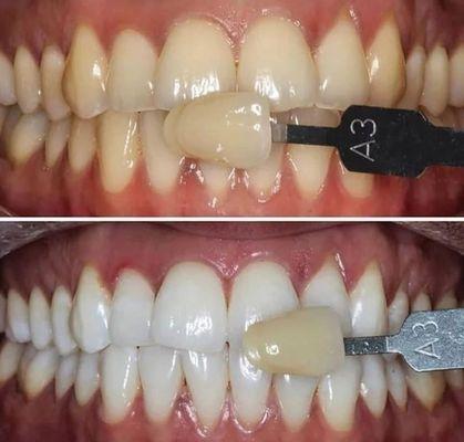 Before and after picture of teeth Whitening .