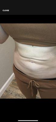 Liposuction results 1year post op