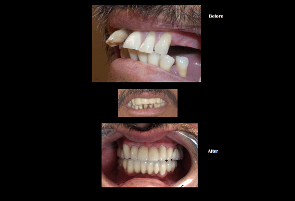 This is a before and after picture. This patient had gum treatment and bridge work.