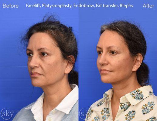 Deep Plane Facelift, Fat Transfer, Endoscopic Browlift, Upper and Lower Blepharoplasty