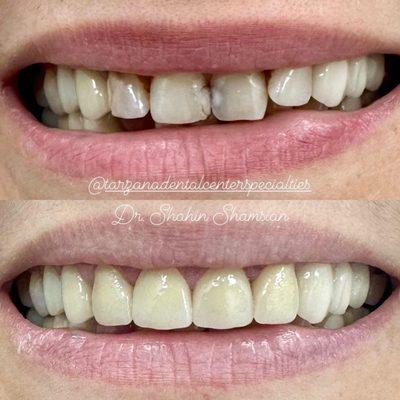 Before & After: 4 root canals and Zirconia crowns. Patient chose a darker shade.